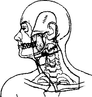 melanoma_ballo2.gif (4921 bytes)
